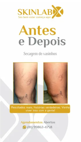 Secagem de vasinhos - varizes 
