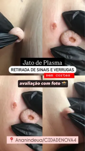 REMOÇÃO DE SINAIS E VERRUGAS @@@@@