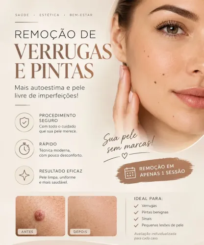 Remoção de verrugas e pintas
