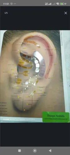 Auriculoterapia