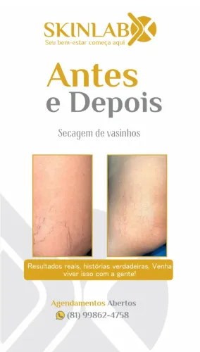 tcchau varizes 