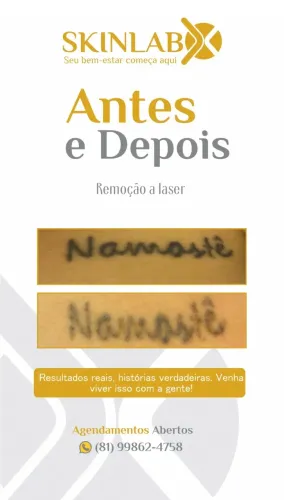 Remoção a laser 