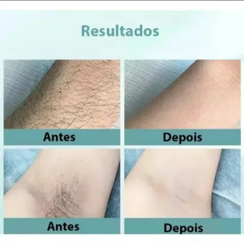 Dispositivo depilador a laser