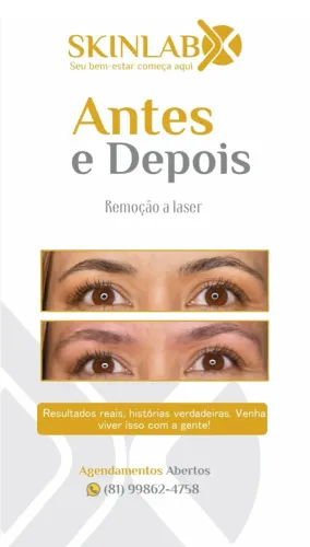 Remoção a laser de micropigmentação de sobrancelhas - SkinLabx