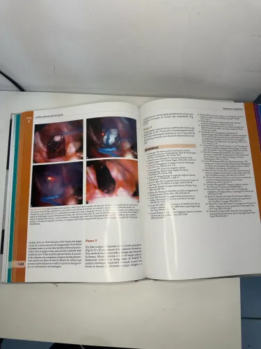 Endoscopia de Laringe? Atlas