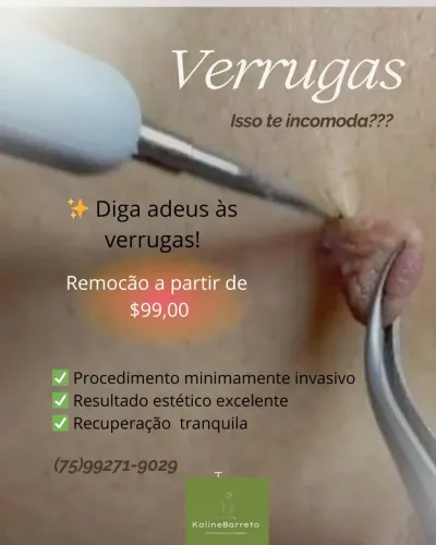 Remoção de verrugas