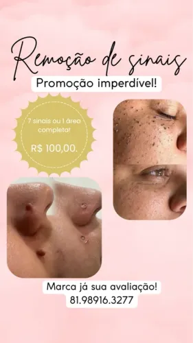 Remoção de Sinais - Promoção Imperdível!