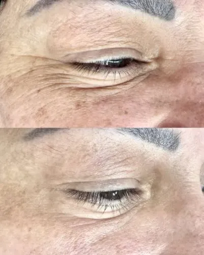 Jato de plasma PLASMAX- APROVADO PELA ANVISA