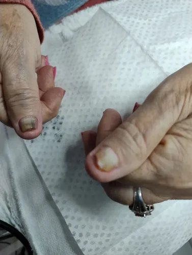 Tratamento para unhas com fungos