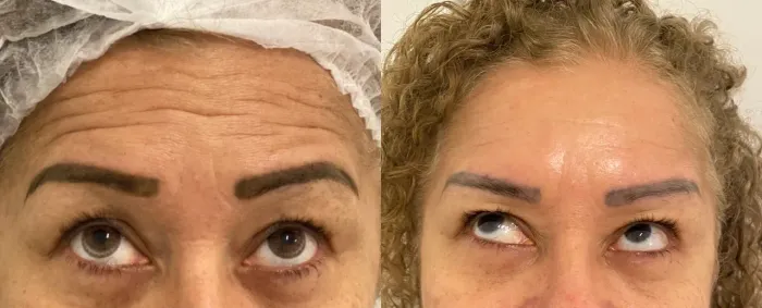 Botox a domicílio 