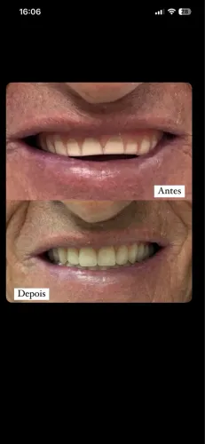 Prótese dentária 