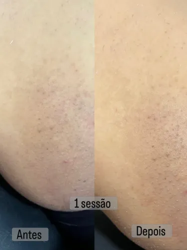 Trabalho com estética de clareamento 