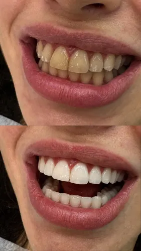 Dentes brancos