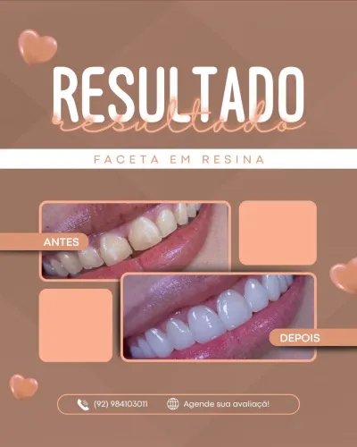 Facetas em resina composta 
