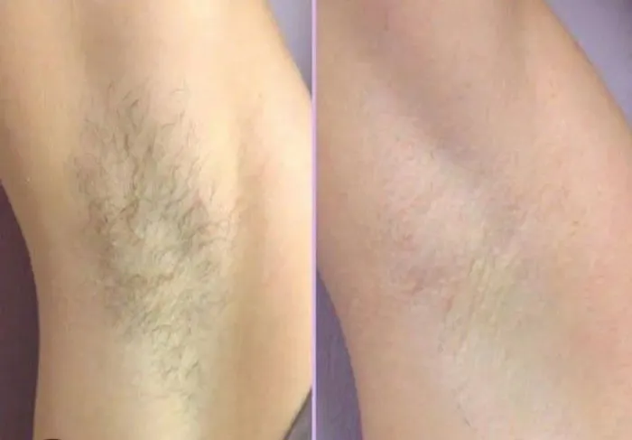 Depilação masculina e feminina 