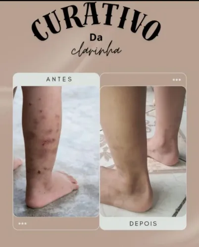 Perebinhas tem solução, sim!