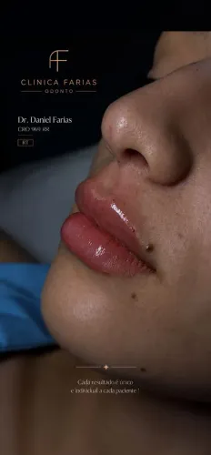 Harmonização Orofacial