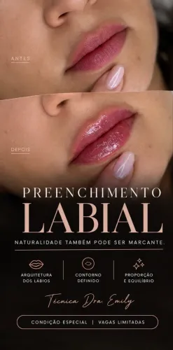 Preenchimento labial