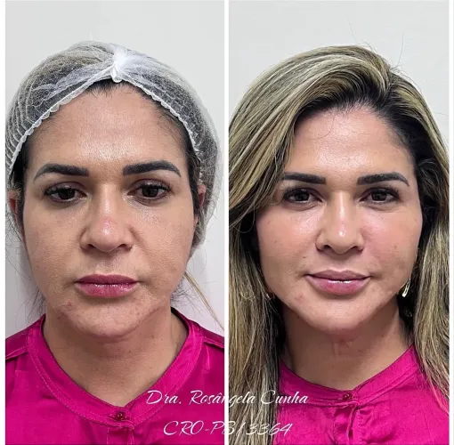 Harmonização facial 