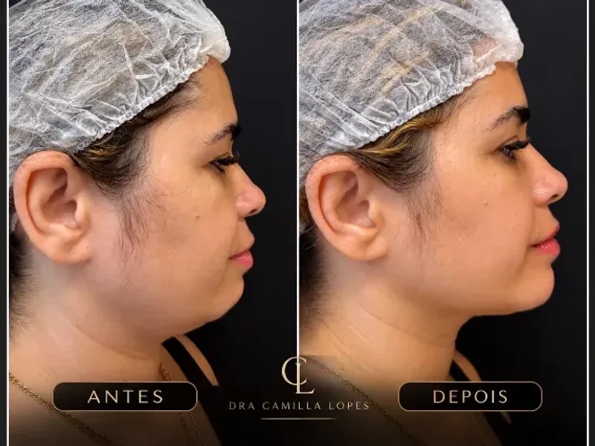 Harmonização facial 