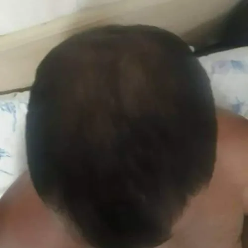 LOÇÃO FORTALECIMENTO E CRESCIMENTO CAPILAR 15% 120 ML