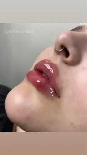 Preenchimento Labial 