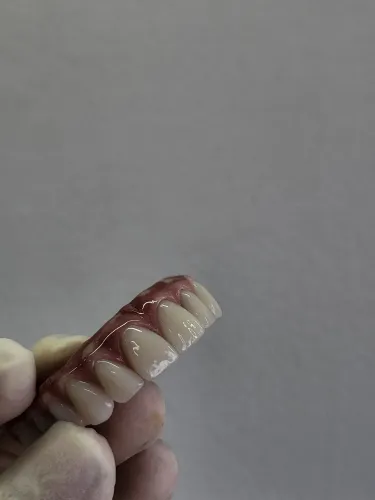 Confecção de dentaduras e proteses com grampo