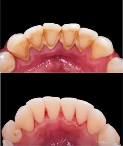 Dentista popular procedimento odontológico com valores simbólicos