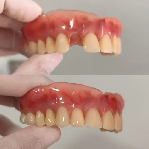 Prótese Dentária