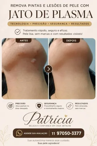 Remoção de pintas e verrugas