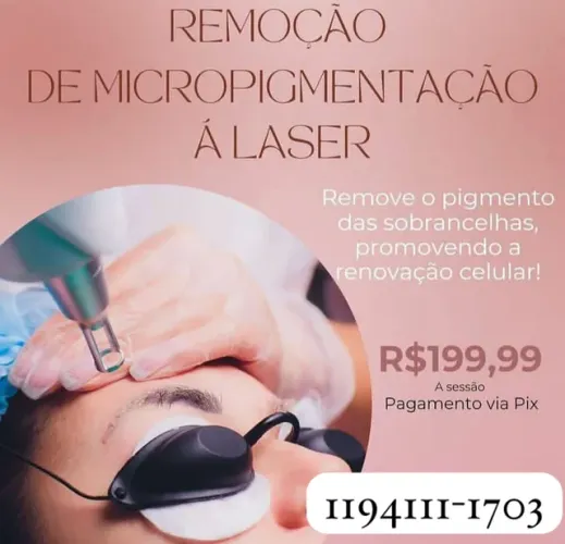 Remoção de tatuagem e micropigmentação a laser