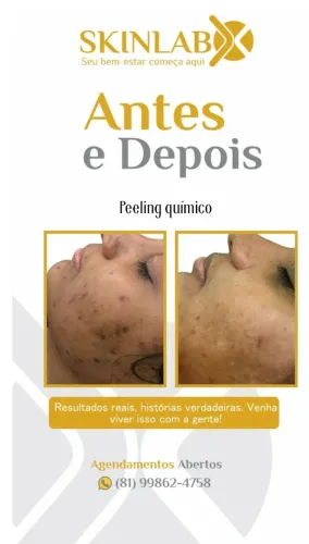 limpeza de pele + 1 sessao peeling quimico para manchas + 1 sesssaoa peeling de hollywood 
