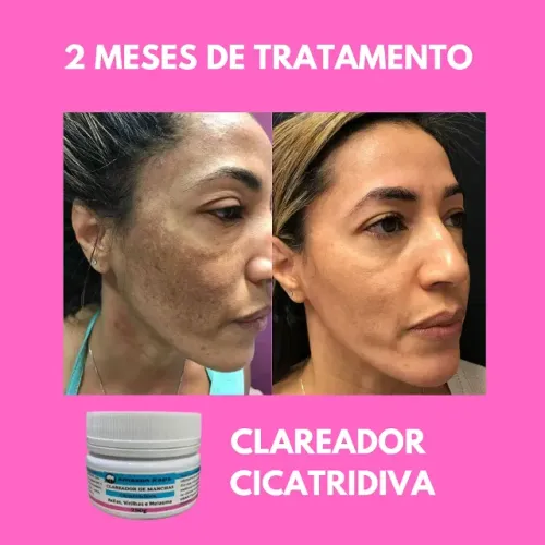 Clareador de Manchas de pele - PAGUE SÓ NA ENTREGA