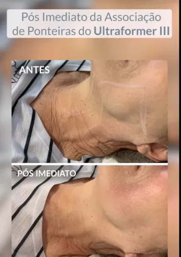Outra forme três aparelho novo
