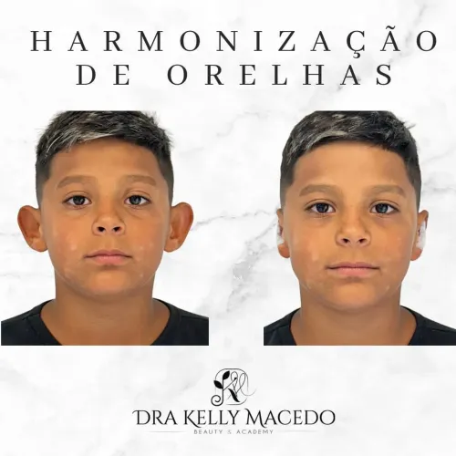 Harmonização de orelhas