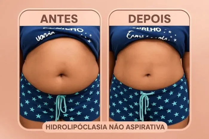 Tratamento de Gordura Localizada - Hidrolipoclasia Não Aspirativa