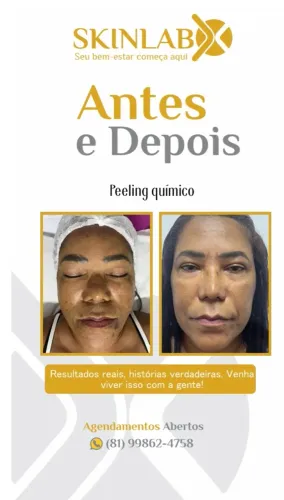 Peeling químico - tratamento para manchas 