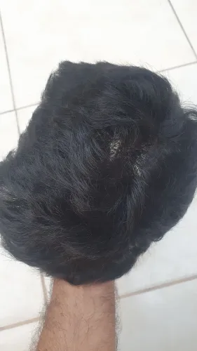 Prótese capilar masculina