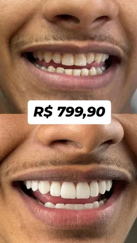 FACETAS EM RESINA