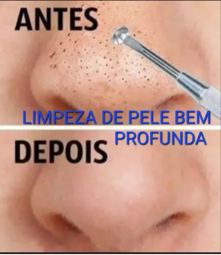 Retirada de verrugas e sinais/ Limpeza de pele bem profunda 