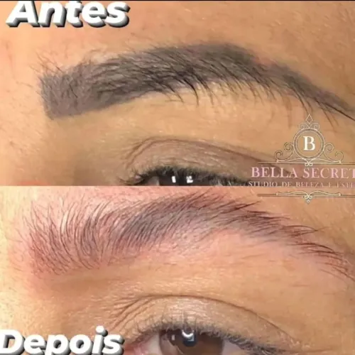 Remoção a laser de Sobrancelha ou Tatuagem 