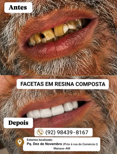 Facetas em resina