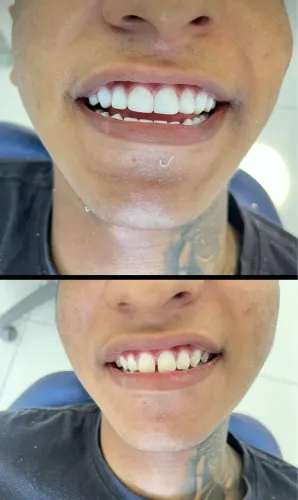 Lentes e Faceta em resina