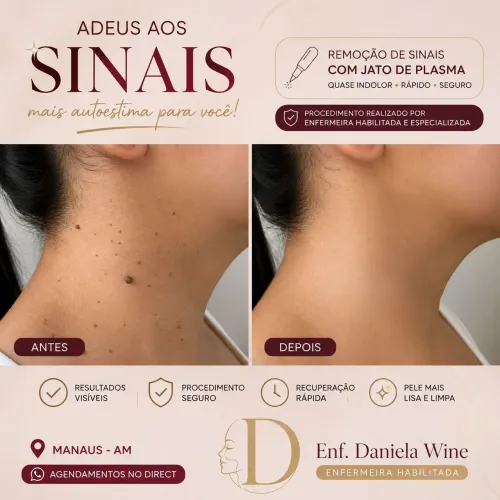 Remoção de sinais