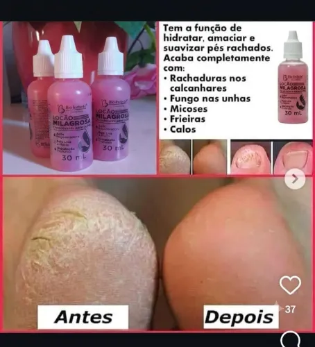 Gotas milagrosa, pés rachados e secos