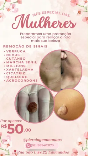 Retirada de sinais e verrugas