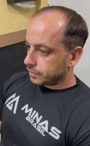 ? Promoção Prótese Capilar ?