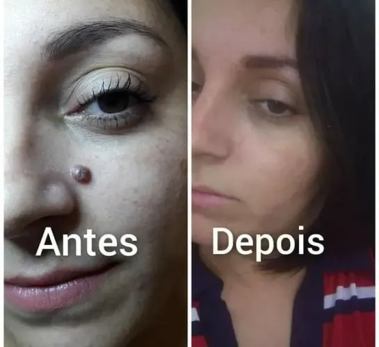 Remoção geral sinal verrugas cicatrizes etc aparti 50 depende do tamanho agenda aberta z