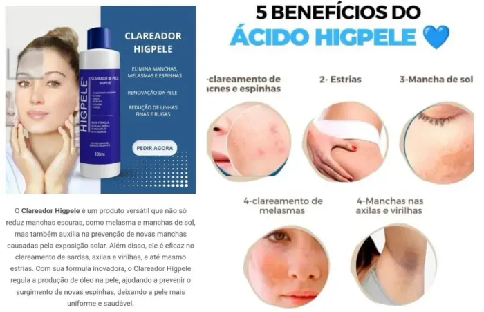 Clareador Facial Higpele - Elimine Manchas, Melasma e Espinhas!