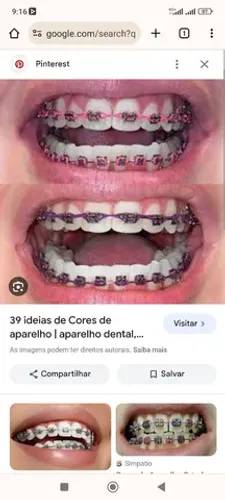 LIGAS DE APARELHO ORTODÔNTICO